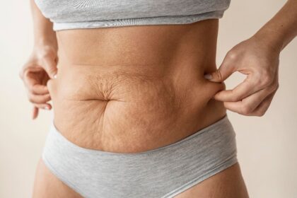 Excesso de pele após emagrecimento: por que acontece e quando a cirurgia deixa de ser estética para virar necessidade